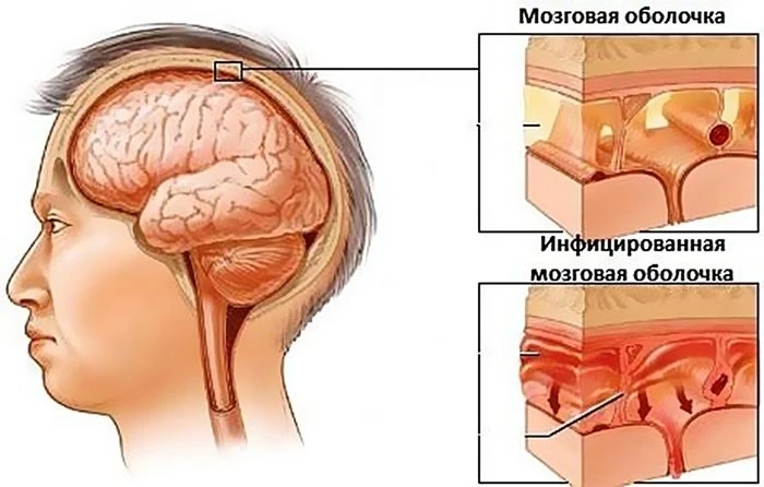 Летом школьники часто болеют серозным менингитом